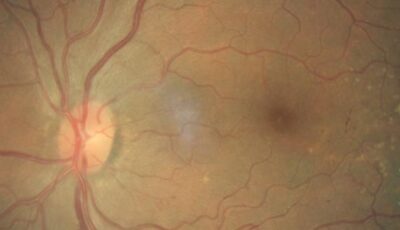 Diabetic Retinopathy & Primary Glaucoma Screening for Underserved Populations